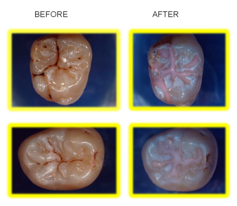 Dental Sealants in Midland, TX West Texas Pediatric Dentistry